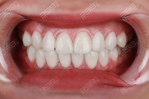 牙齿贴面对自己有什么影响