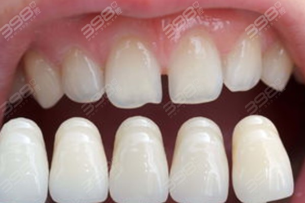 牙齿贴面能保持几年？多少钱一颗？牙贴面日常维护都在这篇文章