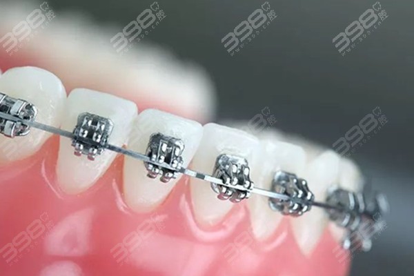 牙齿矫正用钢丝矫正有什么优点和缺点？