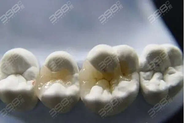 长沙补牙多少钱一颗牙？长沙树脂/嵌体补牙价格及特点大PK