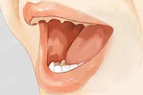 半口牙齿缺失有几种修复方式