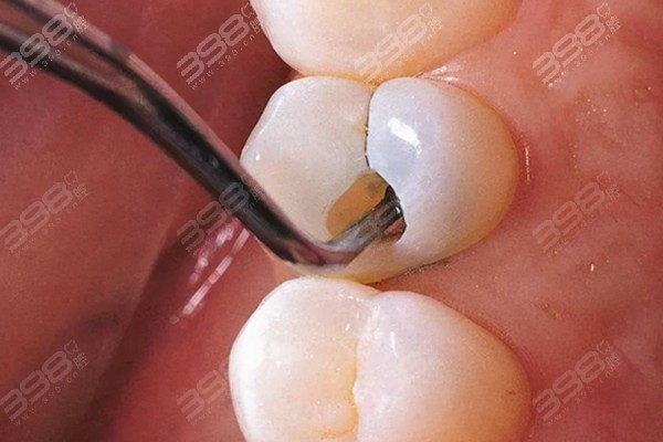 深龋是不是早晚做根管治疗？什么样的蛀牙才需要做根管治疗？
