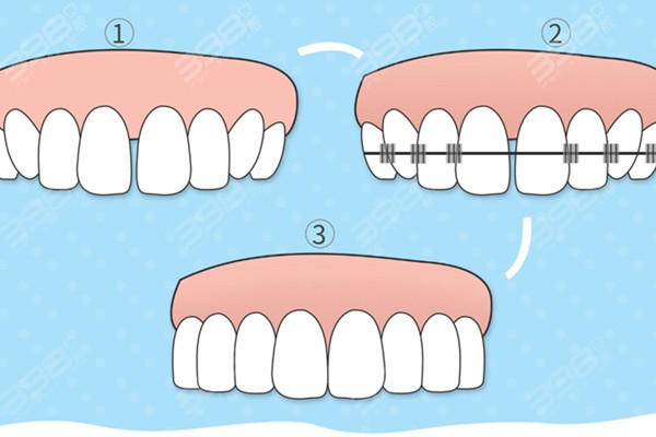 牙齿不整齐矫正大概多少钱？牙齿矫正的费用和这五项挂钩！
