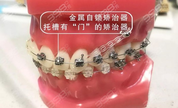 温州口腔医院牙套价格