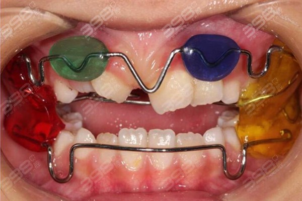儿童牙齿反颌矫正合适年龄