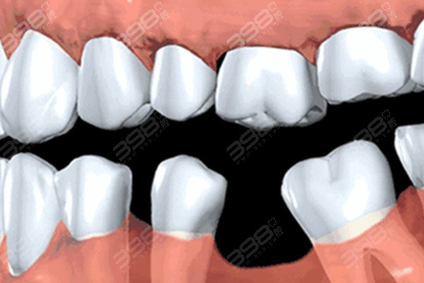 成人牙齿掉了一颗怎么处理？假牙/种植牙有什么优缺点？