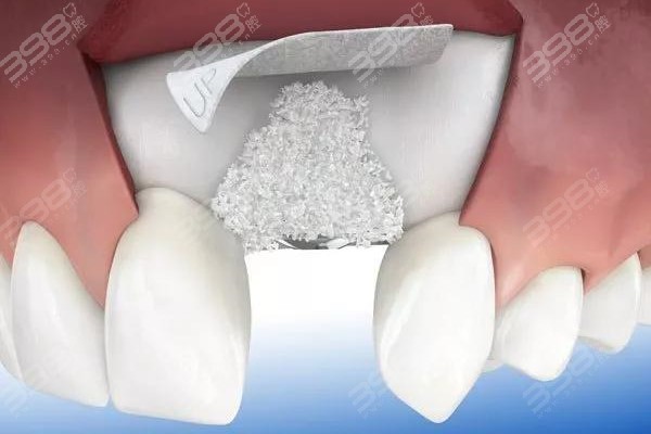 植骨种牙有没有危险？详解种植牙植骨手术的利弊及收费价格