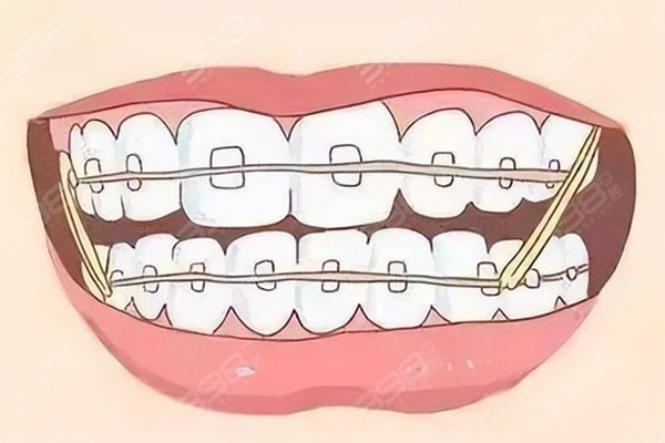 长沙戴牙套哪家牙科医院好一些