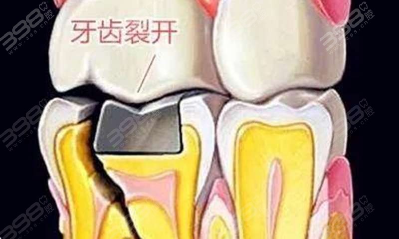 绵阳牙齿根管治疗多少钱