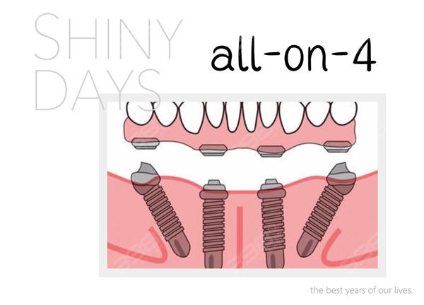 all-on-4种植牙