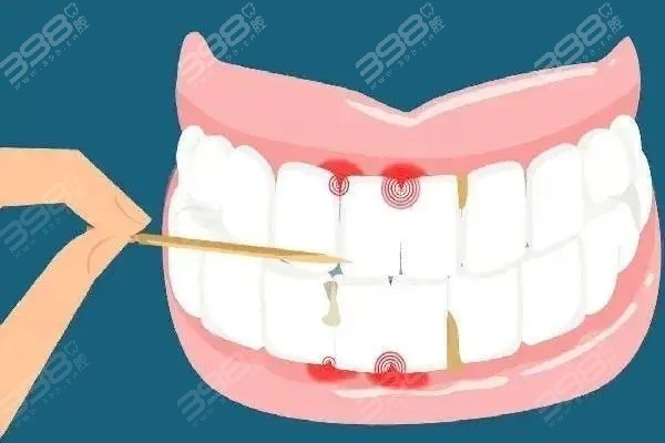 什么是牙龈萎缩