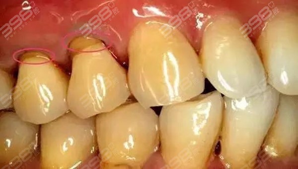 牙龈萎缩的具体特征有哪些