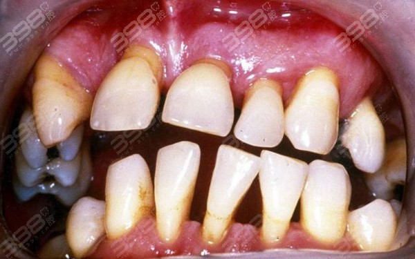 牙龈萎缩的具体特征有哪些