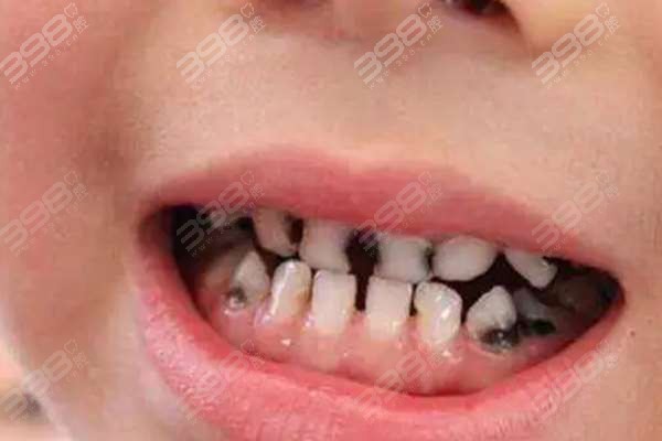 7岁儿童蛀牙已经烂空了怎么办，作为家长还是要警惕