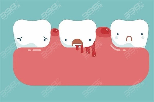 后槽牙时不时会肿起来，是炎症还是蛀牙惹的祸？