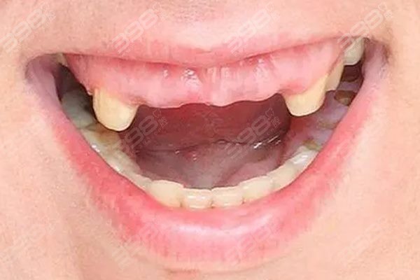 活动假牙哪种戴着舒服？爷爷直夸吸附性义齿、精密附着体义齿排在前