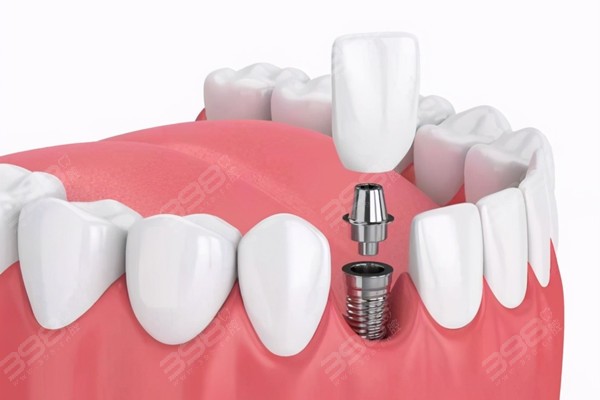 扬州仪征种植牙哪家牙科便宜又好?排名前3种牙技术高价格实惠值得选