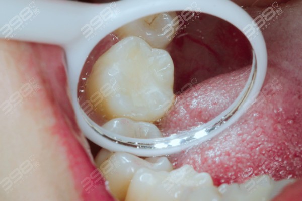 柳州补牙可以用医保吗?分享4家柳州补牙能刷社保卡价格还实惠的牙科
