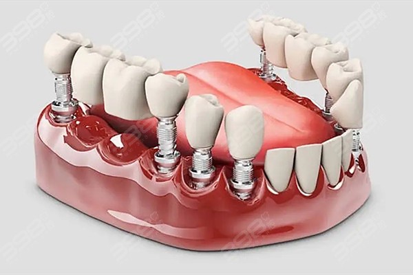 天津口腔医院种一颗牙价格表图片及价格 集采后天津种植牙3000元就能种