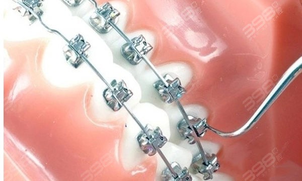 2023杭州上城区牙科医院牙齿矫正多少钱
