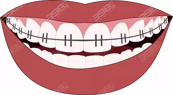 绍兴牙科牙齿矫正收费标准
