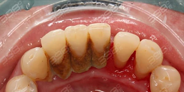 东莞牙状 元口腔医院洗牙多少钱