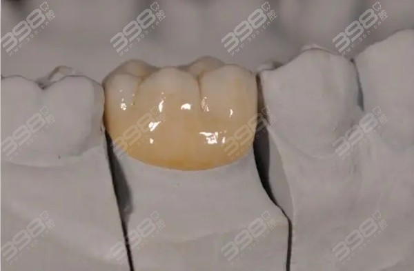 东莞牙状 元口腔医院全瓷牙/瓷贴面/牙齿美白价格表