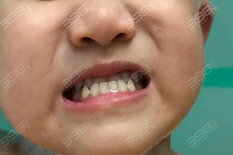 儿童牙齿矫正医院