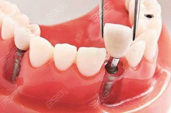 良心医生不建议种植牙的原因之一：种植牙风险过大