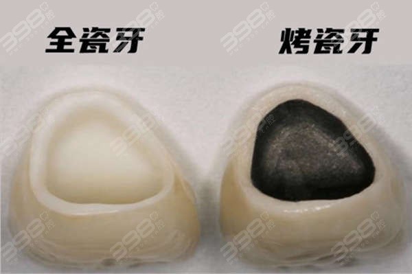广州烤瓷牙收费价格表