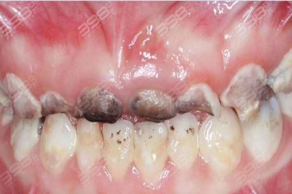 牙根腐蚀了怎么补救？主要是看牙根腐蚀的程度及时就医