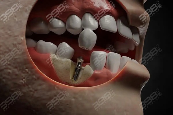 不建议有重度错颌和夜磨症的患者做种植牙