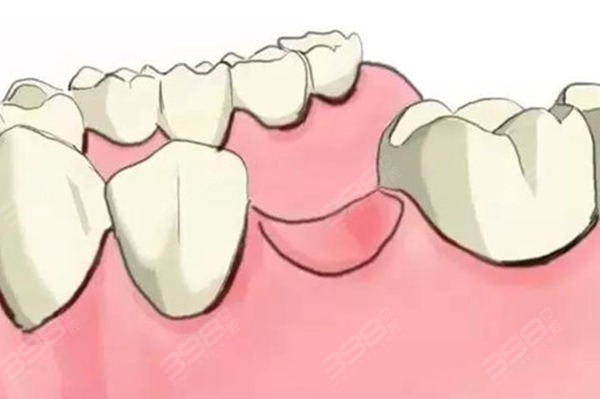 不建议牙周病程度深，有持续性骨吸收的患者做种植牙