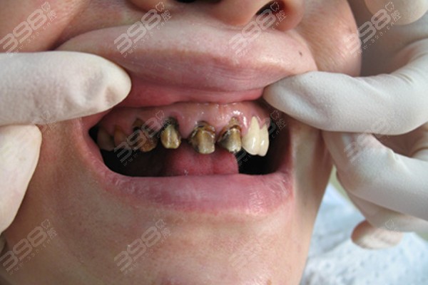 一个牙医的良心忠告种植牙