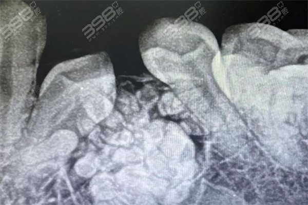 牙瘤