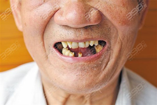 老年人牙齿掉光了怎么办？对比全口种植和义齿修复的优缺点决定