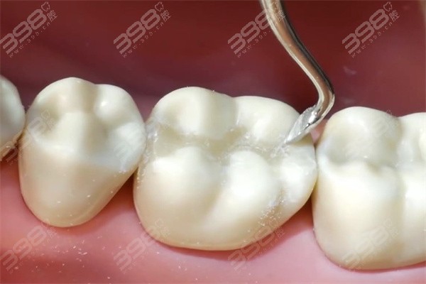流体树脂和固体树脂补牙哪个好？补完牙多久可以正常吃东西呢