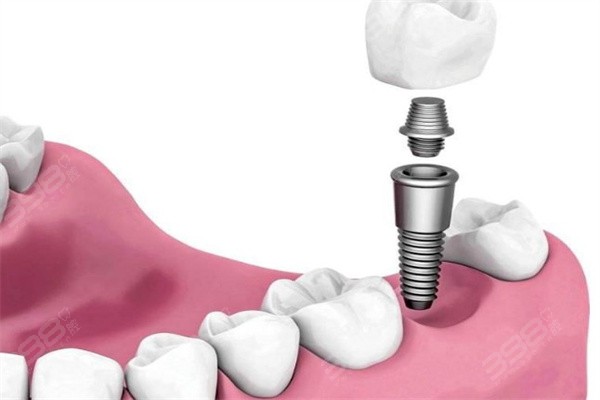 牙齿修复有几种方式？义齿、假牙、种植牙当中如何选择适合自己的方式