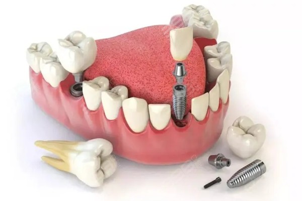 西宁种植牙便宜的牙科医院排名,前5名正规牙科种牙价格低口碑也不赖