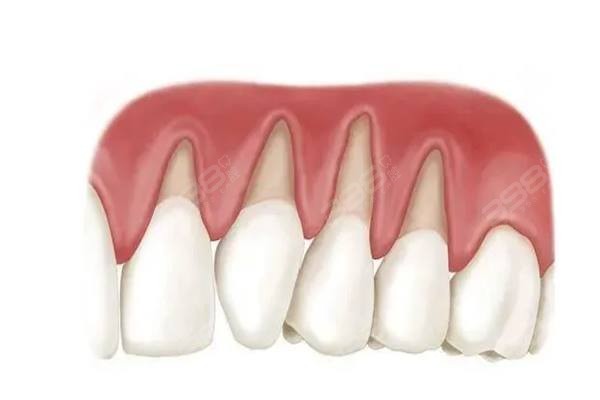 牙齿松动一度二度三度怎么区分？一二级松动程度别灰心还能保住