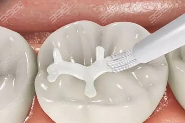 西安补牙收费价格表：顺便了解下补牙哪里便宜能使医保吗