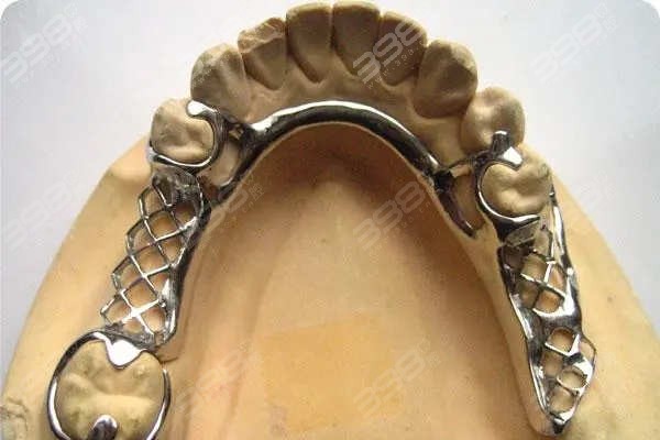 看维他灵支架牙齿图片了解优缺点 对比纯钛活动假牙看哪个更好