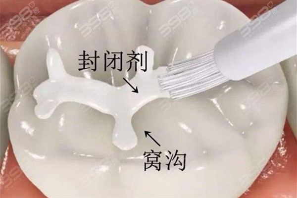 广州海珠区口腔医院儿童齿科看牙收费标准