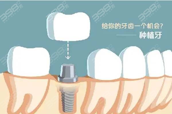 重庆市万州种植牙医院多少钱一颗？万州韩系种牙2990元起
