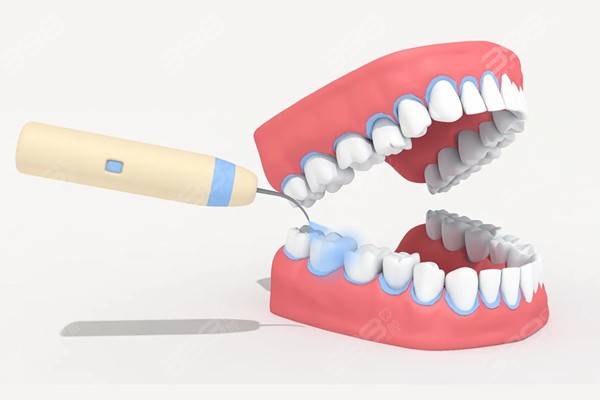 洗牙只是洗出了原本的牙缝 千万不要在误解洗牙了
