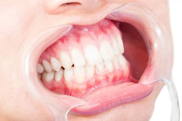 杭州凸嘴牙齿矫正口腔医院排名前十名单