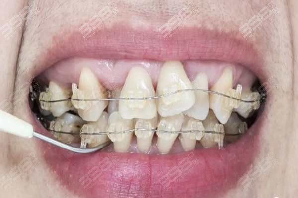 重庆牙齿不齐矫正排名前十的口腔医院：牙博士、牙卫士正畸口碑好价低必去