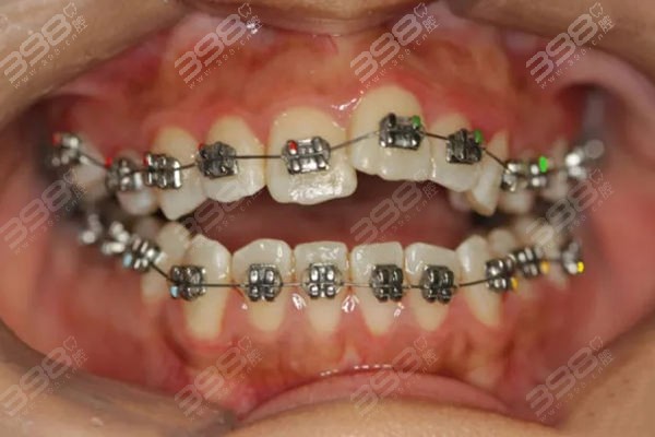 杭州牙齿拥挤龅牙矫正口腔医院排名前十