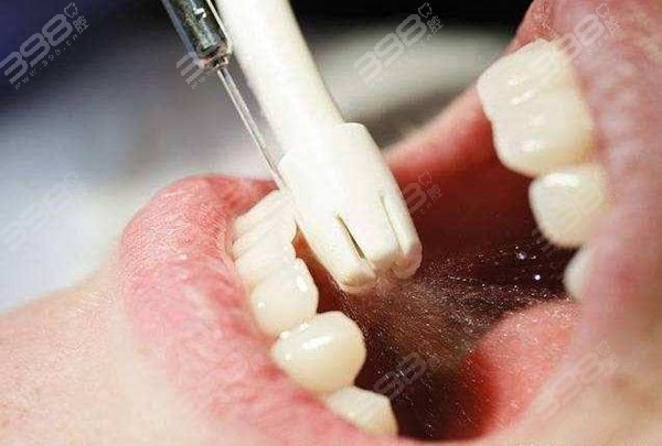洗牙被建议做牙周治疗是套路吗？深入了解两者的区别和重要性