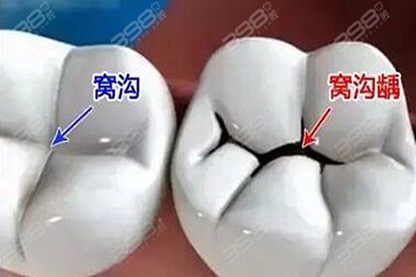 广州窝沟封闭口腔医院排名top10 广大/青苗/穗华口腔做儿牙治疗名列前茅